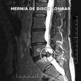 Ressonância Nuclear Magnética com Hérnia Discal Lombar