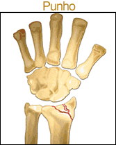 Fratura de punho (Colles) devido a osteoporose