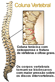 Fratura vertebral na osteoporose