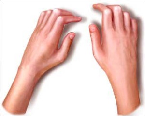 Esclerodactilia-dedos mais grossos, pele mais brilhante e limitação dos movimentos