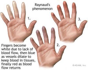 Fases do Fenômeno de Raynaud:1-Palidez (branco), 2-Cianose (roxo) 3-Eritematoso (vermelho)