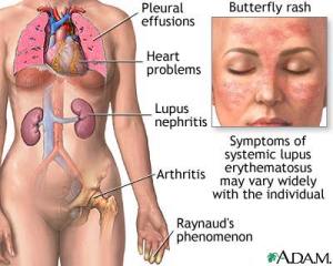  O lupus eritematoso sistêmico agride vários órgãos do nosso corpo.