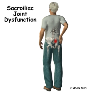 A lombalgia por inflamação da articulação sacroilíaca é comum